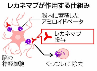 アルツハイマー症の特効薬